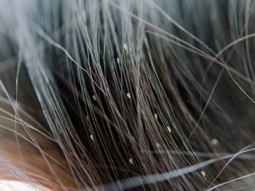 10 Cara Membasmi Habis Kutu Rambut Hingga Telurnya dengan Bahan Alami dan Aman